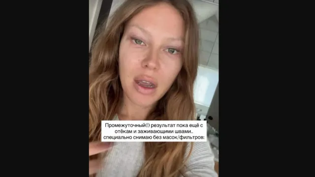 Рита Дакота показала результат своей пластической операции